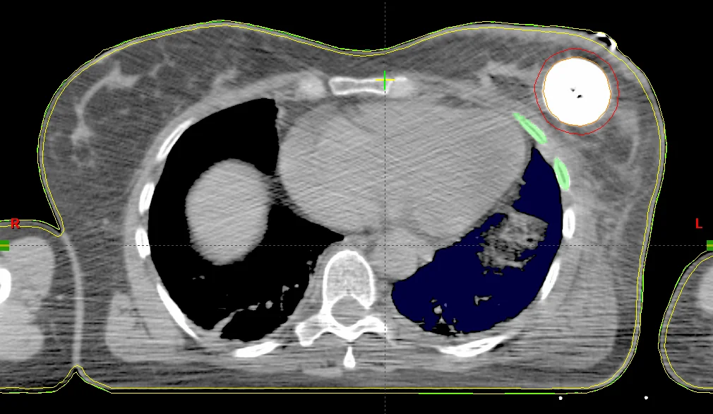 Transverales CT-Schnittbild mit einem linksseitigen MammoSite-Ballon.