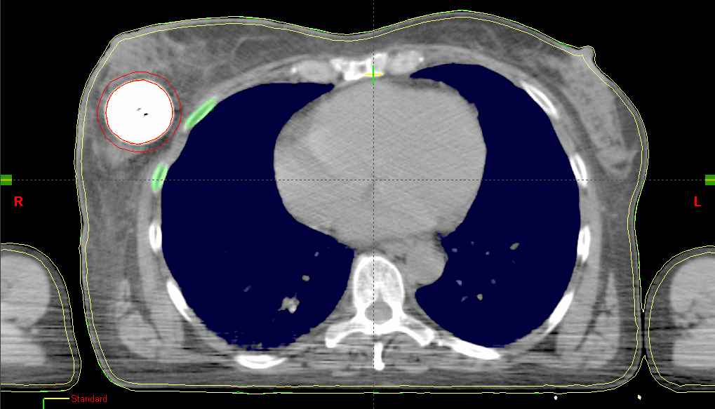 Transverales CT-Schnittbild mit einem rechtsseitigen MammoSite-Ballon.