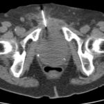 Radiologie - CT-Intervention (Abszessdrainage)