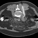 Radiologie - CT-Intervention (Nadelbiopsie)