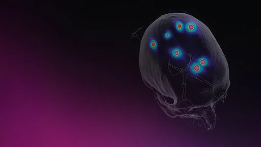 brainlab rt elements key visual multiple brain mets 512x288